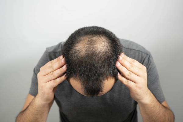 hair loss balding grey hair