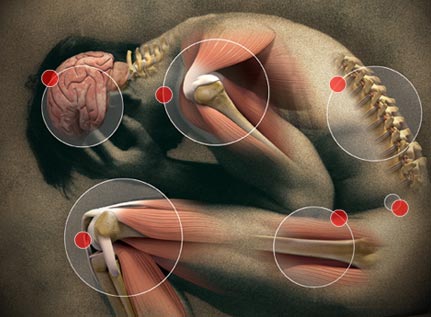 dermatomyositis