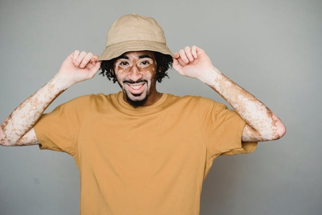 vitiligo