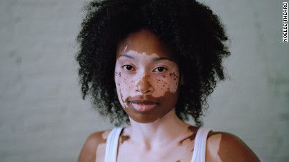 vitiligo